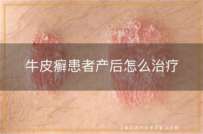 牛皮癣患者产后怎么治疗