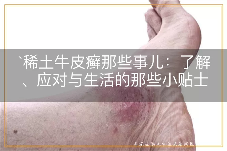 稀土牛皮癣那些事儿：了解、应对与生活的那些小贴士
