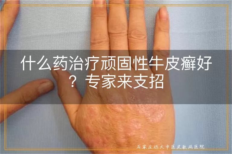 什么药治疗顽固性牛皮癣好？专家来支招
