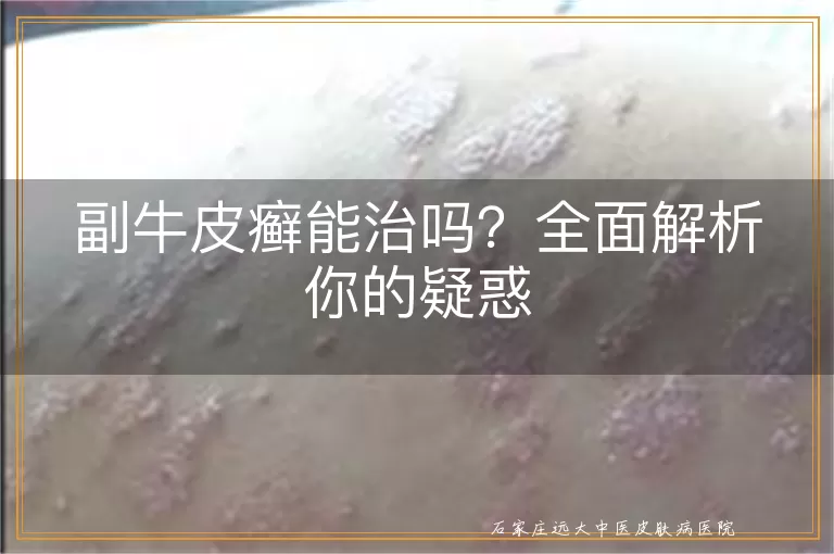 副牛皮癣能治吗？全面解析你的疑惑