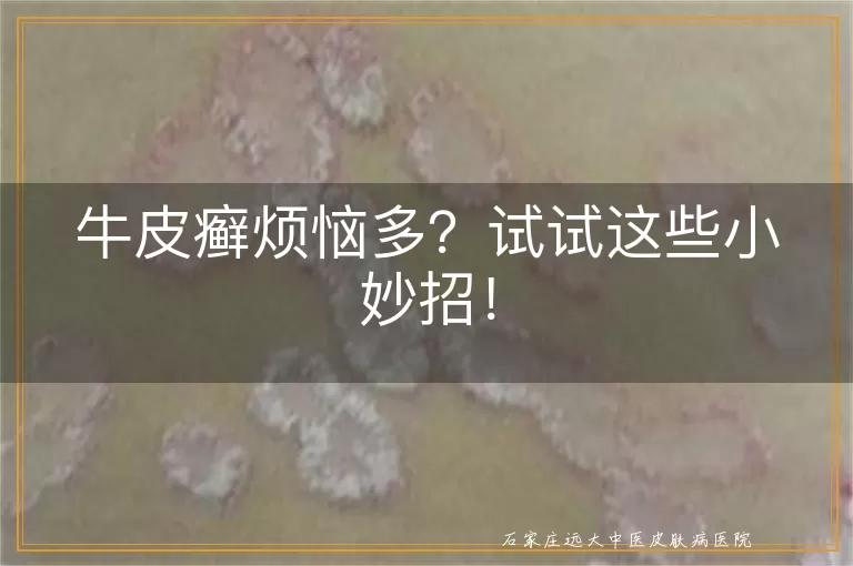 牛皮癣烦恼多？试试这些小妙招！