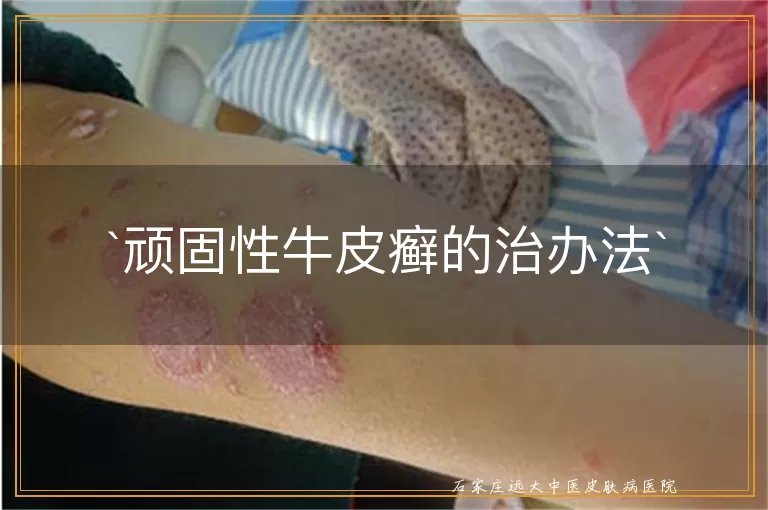 顽固性牛皮癣的治办法