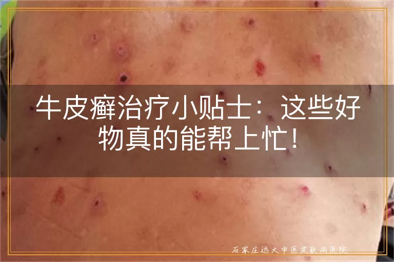 牛皮癣治疗小贴士：这些好物真的能帮上忙！