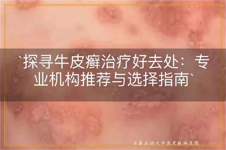 探寻牛皮癣治疗好去处:专业机构推荐与选择指南