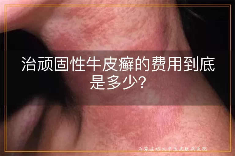 治顽固性牛皮癣的费用到底是多少？
