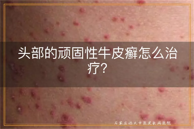 头部的顽固性牛皮癣怎么治疗？