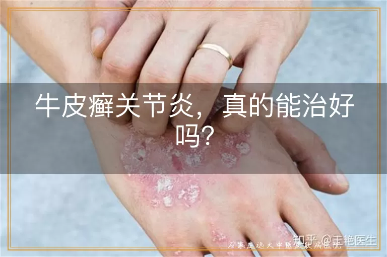 牛皮癣关节炎，真的能治好吗？