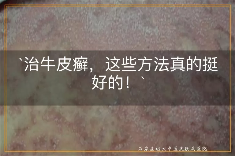 治牛皮癣，这些方法真的挺好的！
