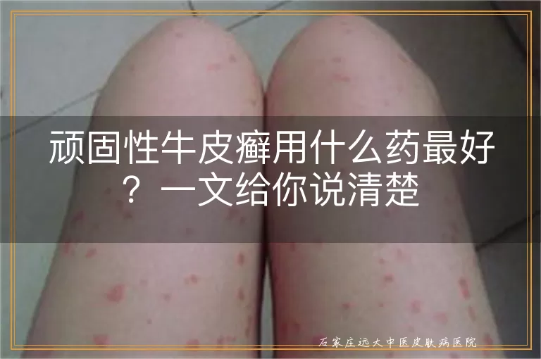 顽固性牛皮癣用什么药最好？一文给你说清楚