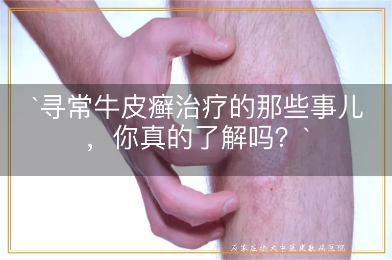 寻常牛皮癣治疗的那些事儿,你真的了解吗?