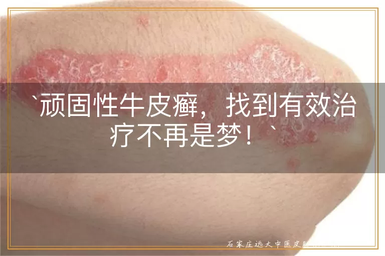 顽固性牛皮癣,找到有效治疗不再是梦!