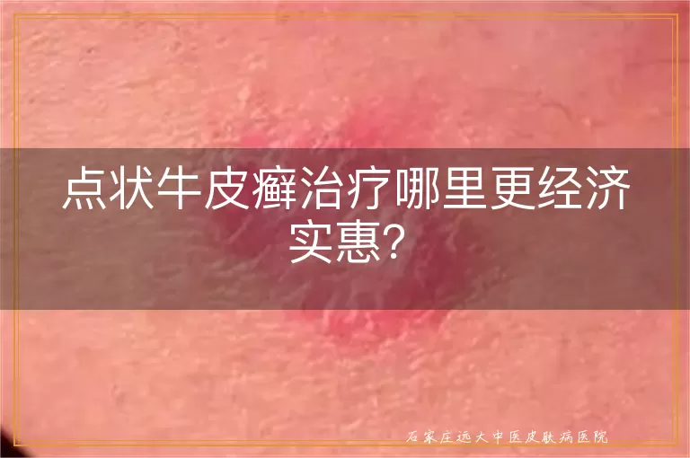 点状牛皮癣治疗哪里更经济实惠?