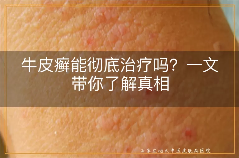 牛皮癣能彻底治疗吗?一文带你了解真相