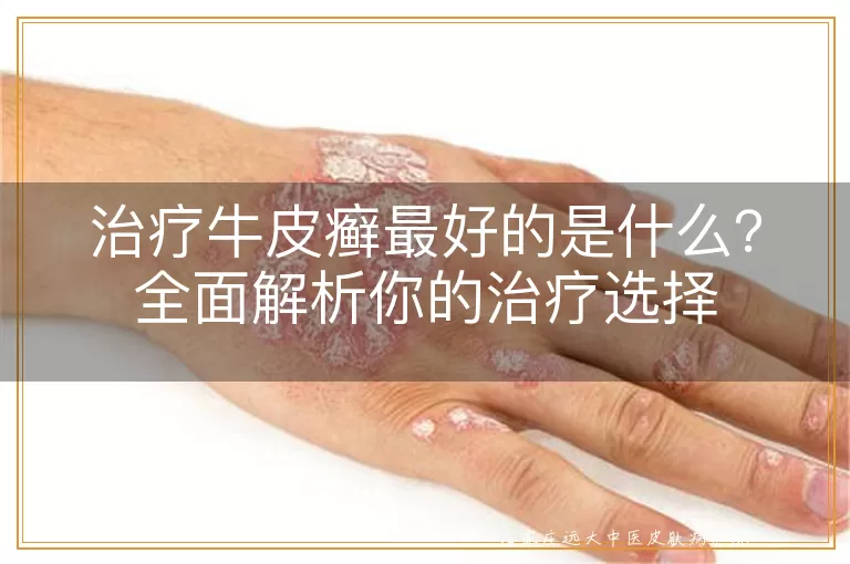 治疗牛皮癣最好的是什么?全面解析你的治疗选择