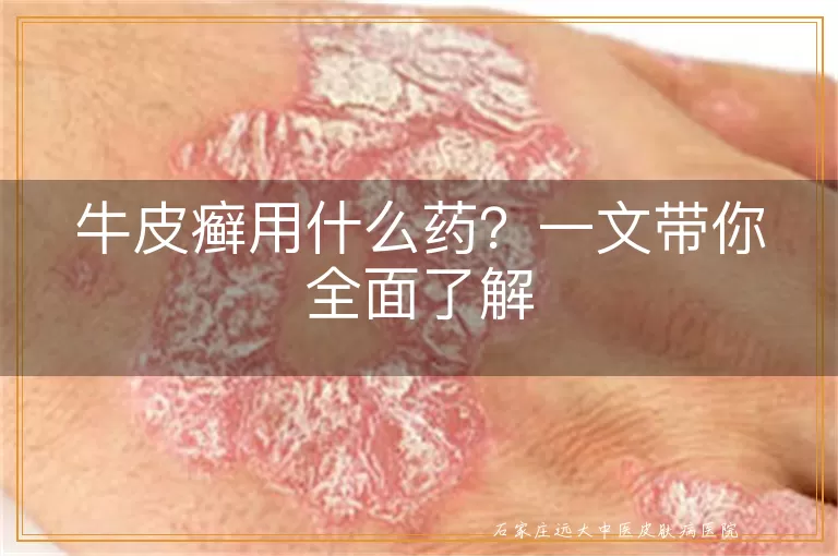 牛皮癣用什么药?一文带你全面了解