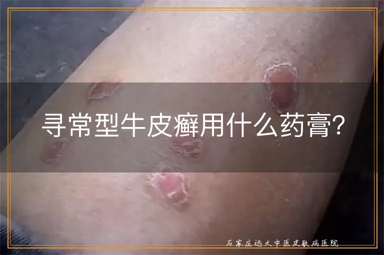 寻常型牛皮癣用什么药膏?