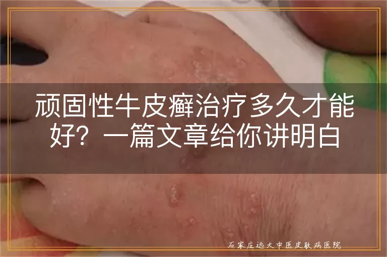 顽固性牛皮癣治疗多久才能好?一篇文章给你讲明白