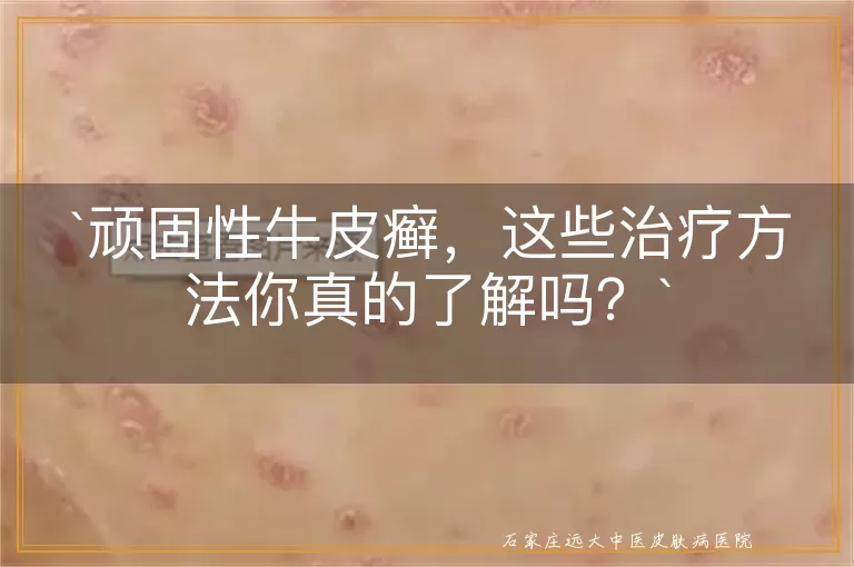 顽固性牛皮癣,这些治疗方法你真的了解吗?