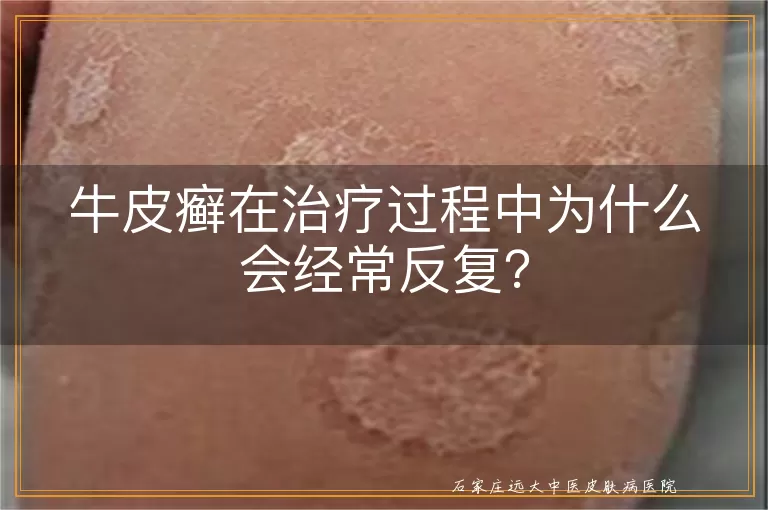 牛皮癣在治疗过程中为什么会经常反复?