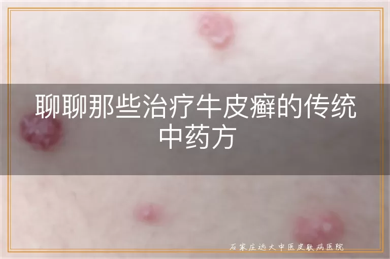 聊聊那些治疗牛皮癣的传统中药方