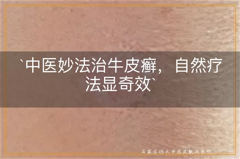 中医妙法治牛皮癣,自然疗法显奇效