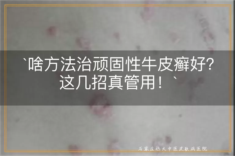 啥方法治顽固性牛皮癣好？这几招真管用！