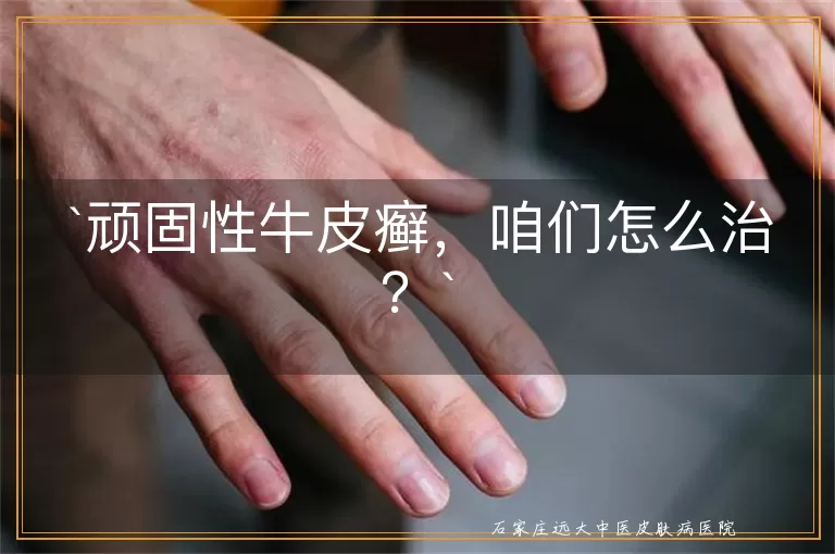 顽固性牛皮癣，咱们怎么治？