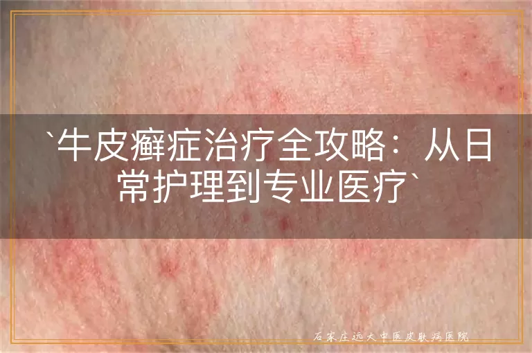 牛皮癣症治疗全攻略：从日常护理到专业医疗