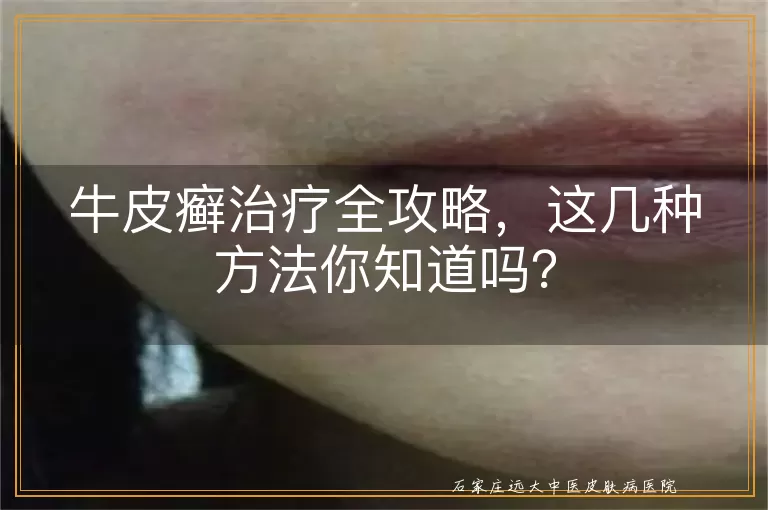 牛皮癣治疗全攻略，这几种方法你知道吗？