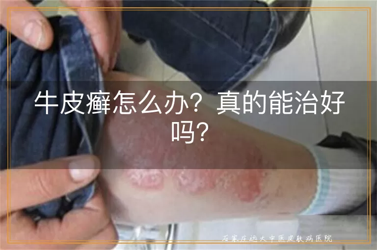 牛皮癣怎么办？真的能治好吗？