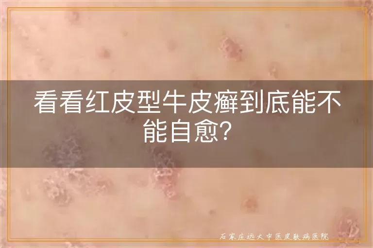 看看红皮型牛皮癣到底能不能自愈?