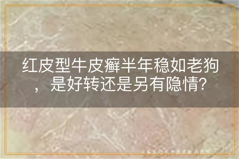 红皮型牛皮癣半年稳如老狗，是好转还是另有隐情？