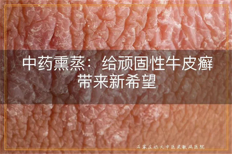 中药熏蒸：给顽固性牛皮癣带来新希望