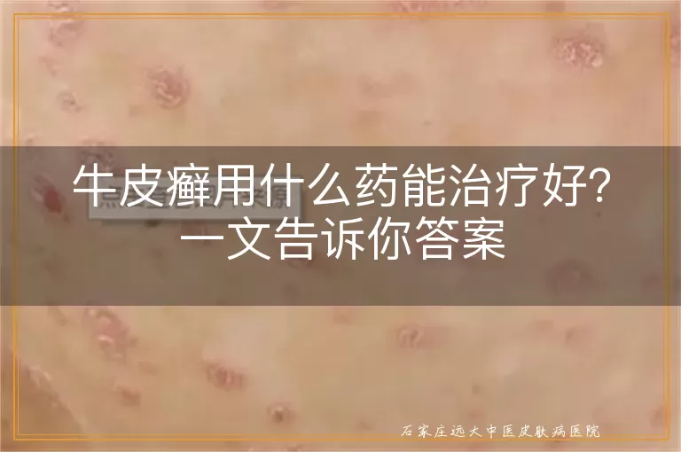 牛皮癣用什么药能治疗好?一文告诉你答案