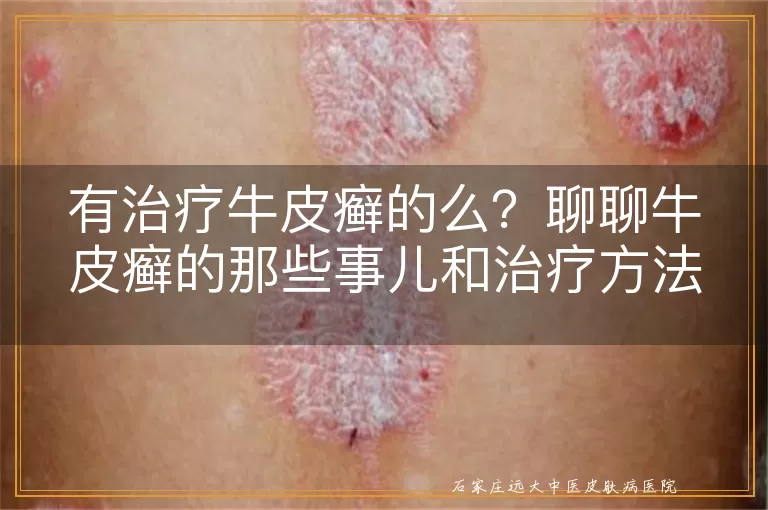 有治疗牛皮癣的么？聊聊牛皮癣的那些事儿和治疗方法