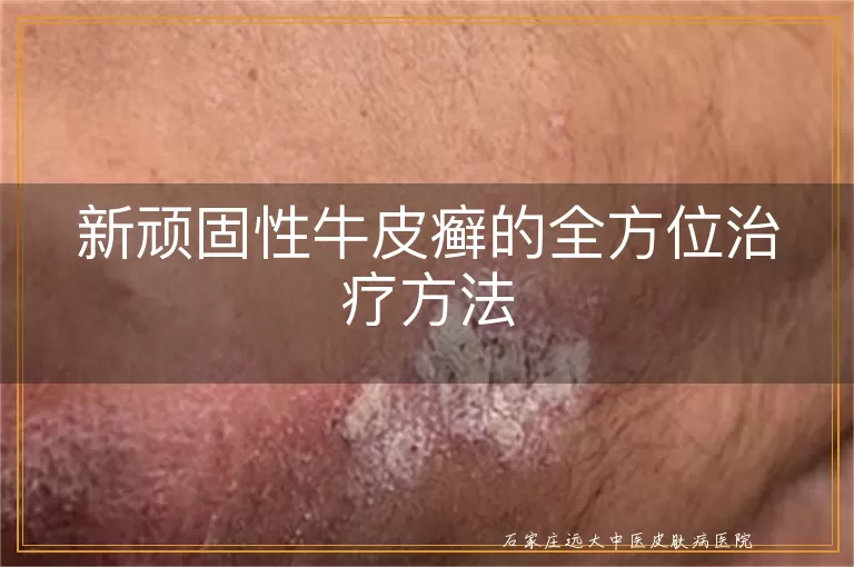 新顽固性牛皮癣的全方位治疗方法