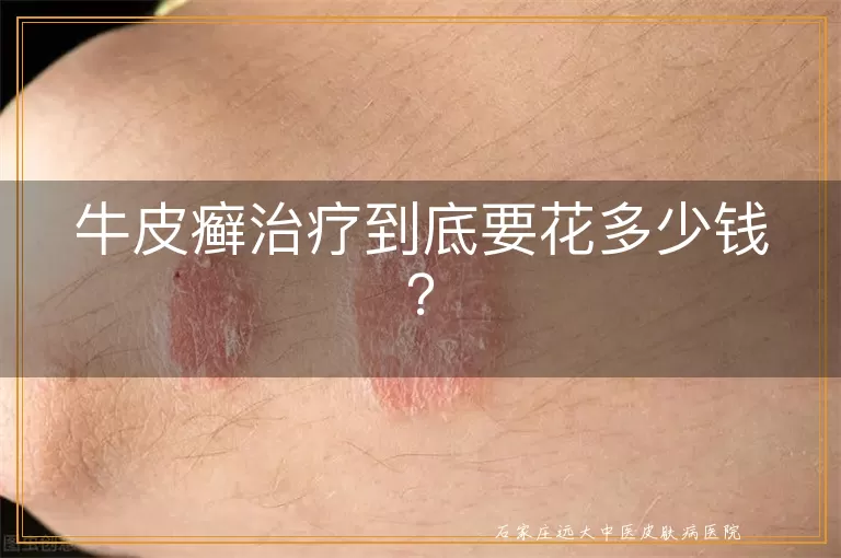 牛皮癣治疗到底要花多少钱？