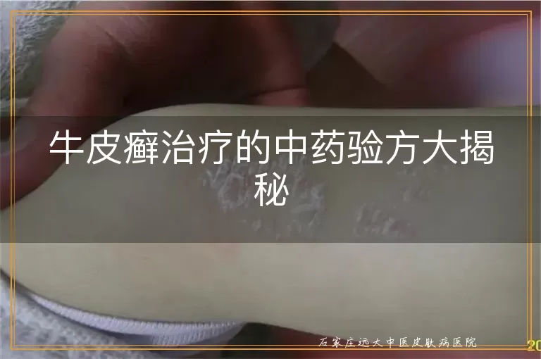 牛皮癣治疗的中药验方大揭秘