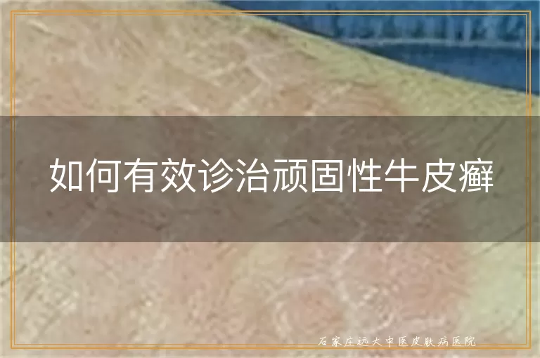 如何有效诊治顽固性牛皮癣