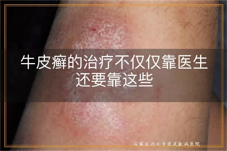 牛皮癣的治疗不仅仅靠医生还要靠这些