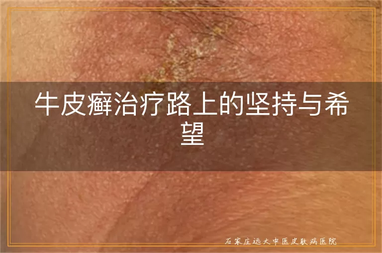 牛皮癣治疗路上的坚持与希望