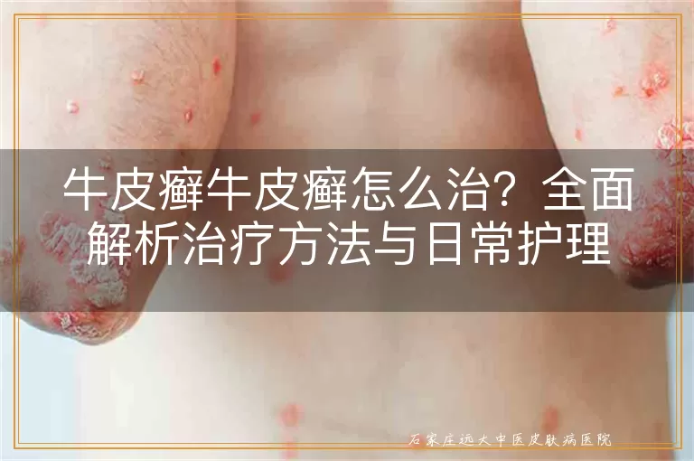 牛皮癣牛皮癣怎么治?全面解析治疗方法与日常护理