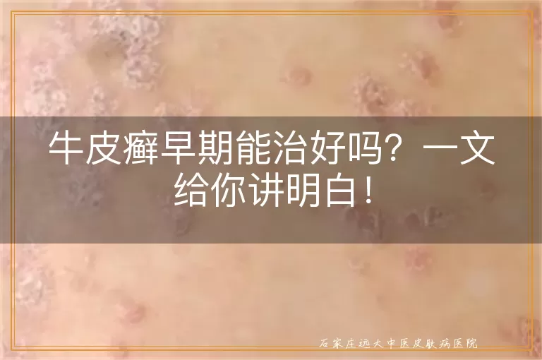 牛皮癣早期能治好吗?一文给你讲明白!