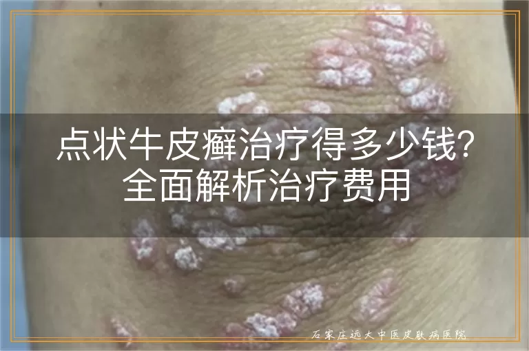 点状牛皮癣治疗得多少钱?全面解析治疗费用