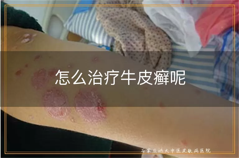 怎么治疗牛皮癣呢