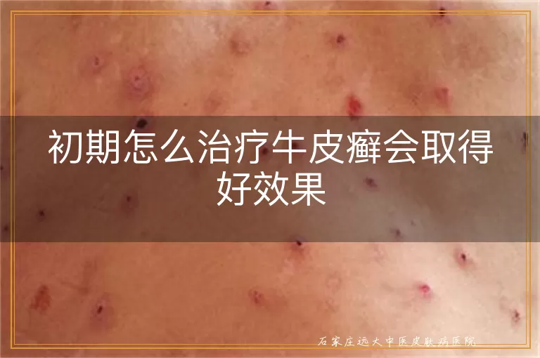 初期怎么治疗牛皮癣会取得好效果