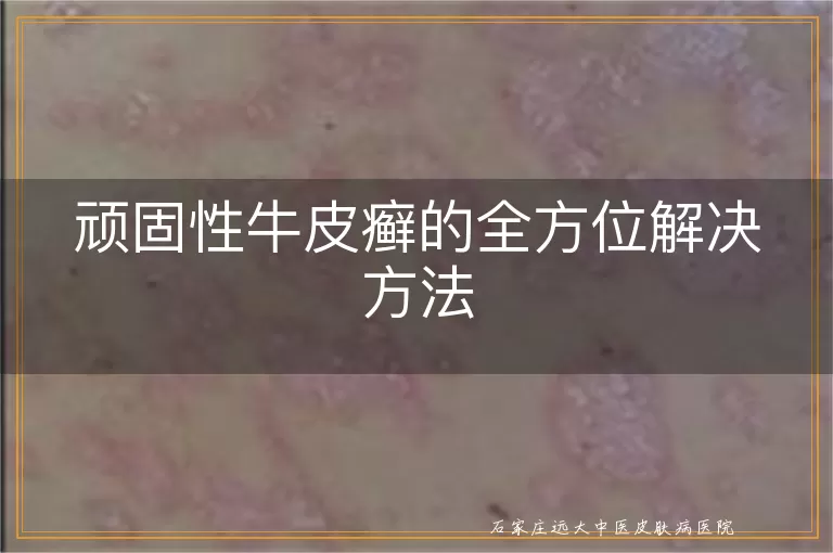 顽固性牛皮癣的全方位解决方法