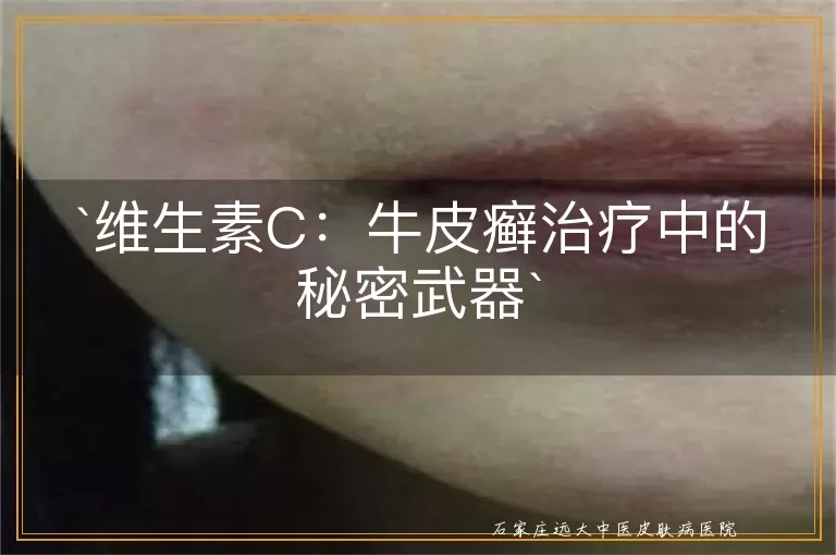 维生素C：牛皮癣治疗中的秘密武器