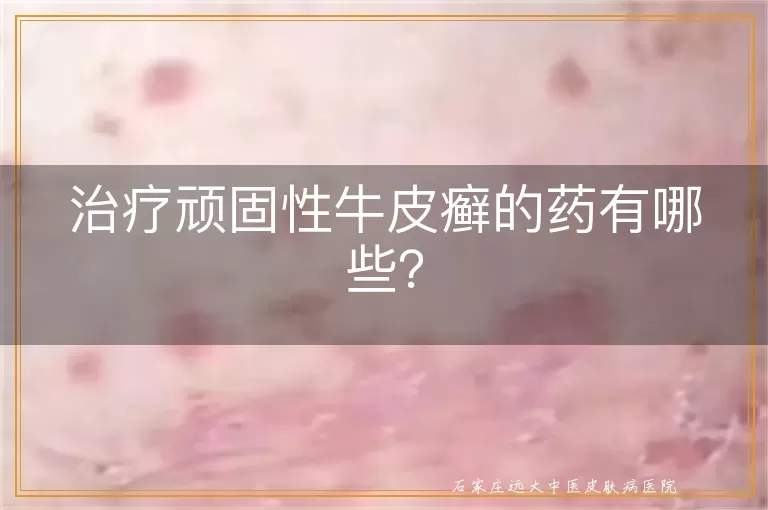 治疗顽固性牛皮癣的药有哪些?