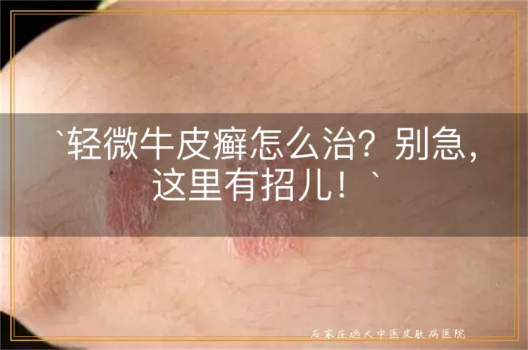 轻微牛皮癣怎么治?别急,这里有招儿!